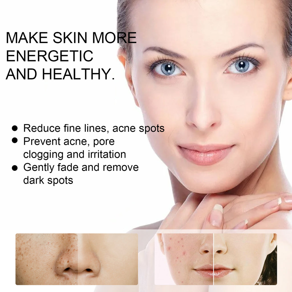 Anti-Acne and Blemishes Skin Care Cream – Brightening, Moisturizing & Anti-Acne Daily Care - Icon Her